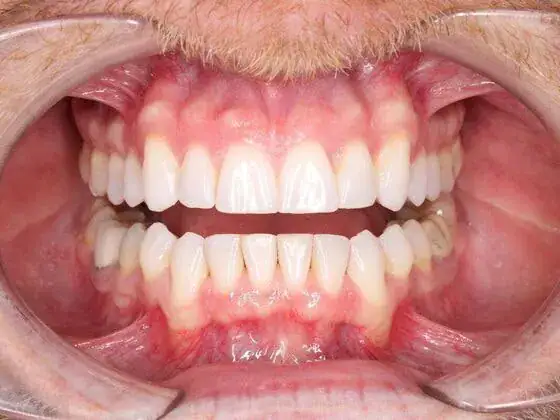 After Invisalign