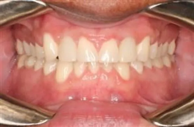 After Braces