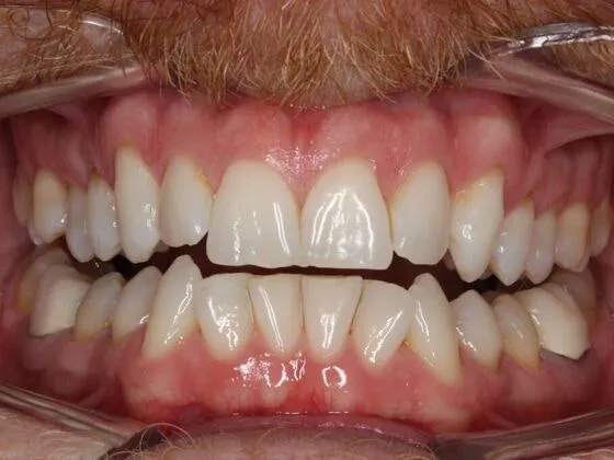 Before Invisalign
