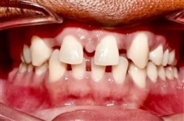 Before Braces