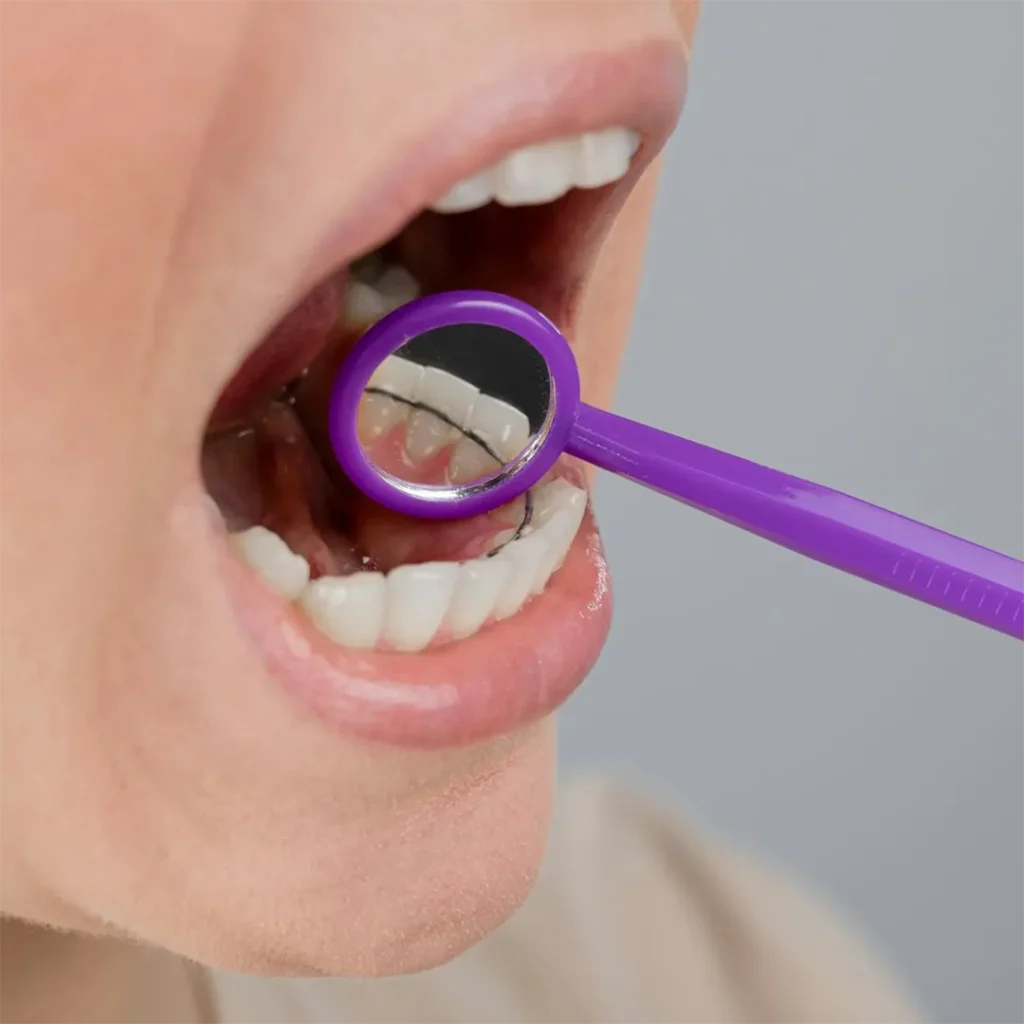 Lingual braces